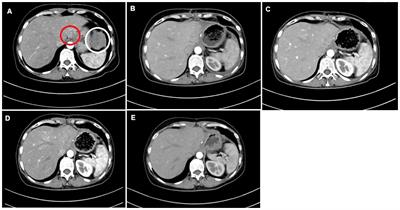 Combined NK-CIK and PD-1 inhibitor (nivolumab), an effective immunotherapy for treating intrahepatic lymphoepithelioma-like cholangiocarcinoma unassociated with EBV infection: Two case reports and a literature review